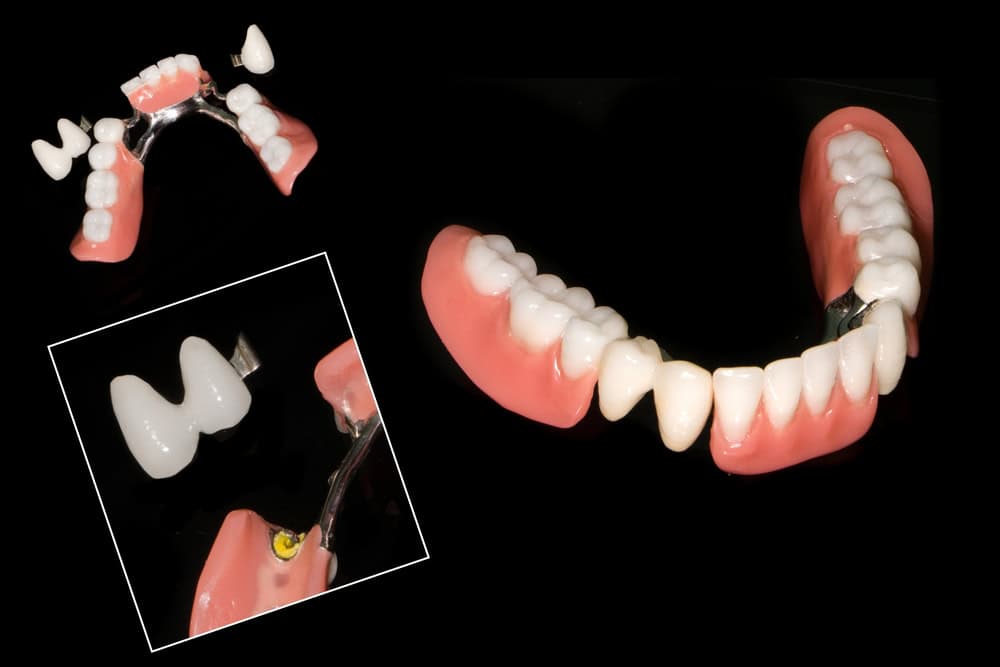 Perfect-dental zasuvne spoje