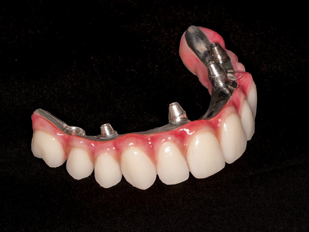 Perfect-dental můstky